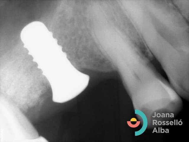 Periodontitis e implantes dentales