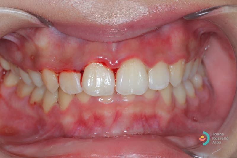 síntomas de la periodontitis