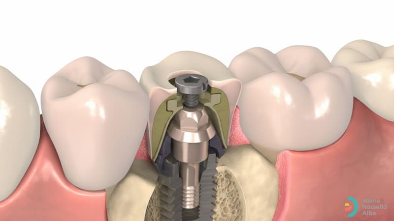 injertos oseos en palma mallorca