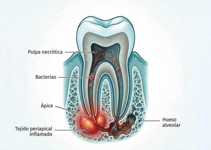 periodontitis apical infeccion encias