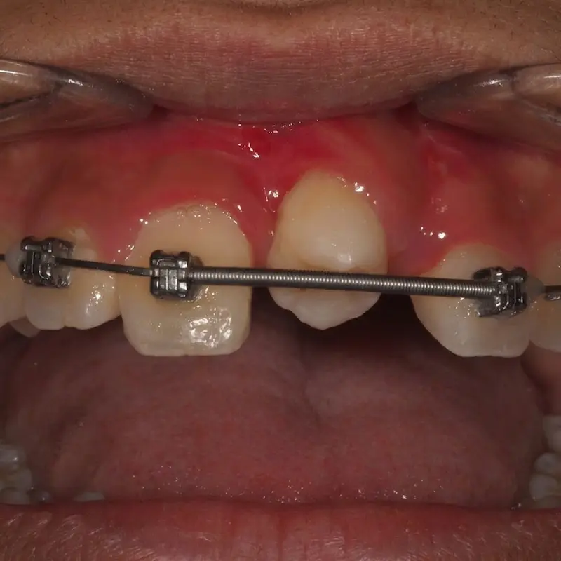 Autotrasplante dental en Palma