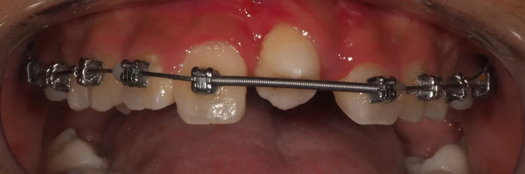 Como es un autotrasplante dental